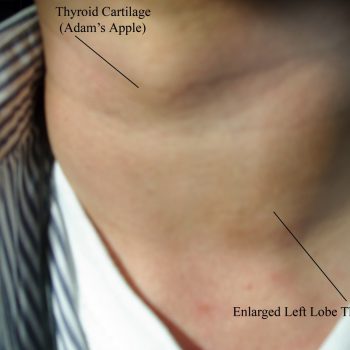 lymph node inflammation in the neck