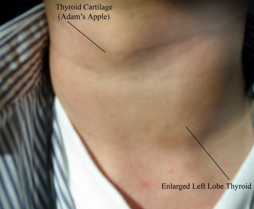 lymph node inflammation in the neck